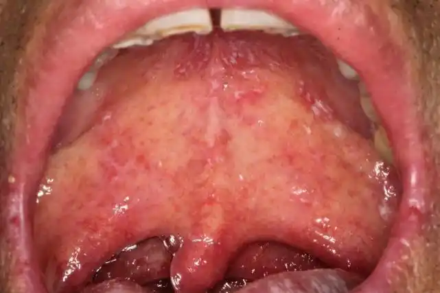 【口腔医学会专栏】艾滋病口腔黏膜病损及治疗