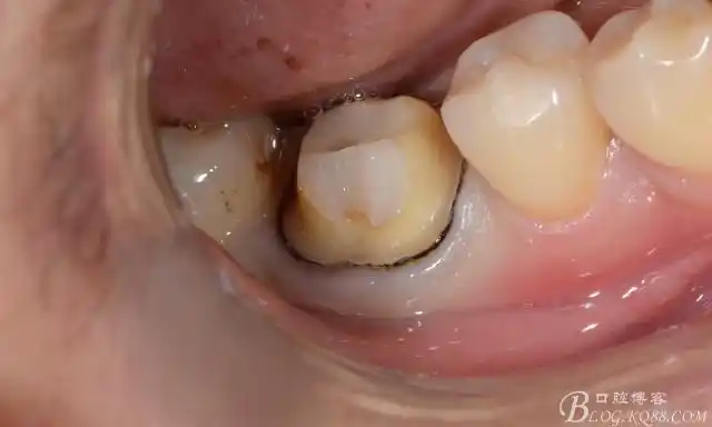 后牙根管治疗后桩核单冠修复