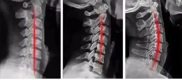 枕头选不对睡觉伤颈椎这款亚朵酒店同款安眠枕护颈又助眠今日不到半价