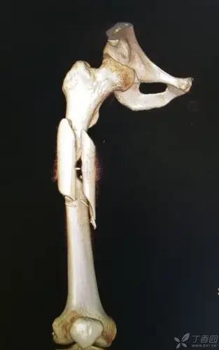 股骨干骨折,感觉好难.