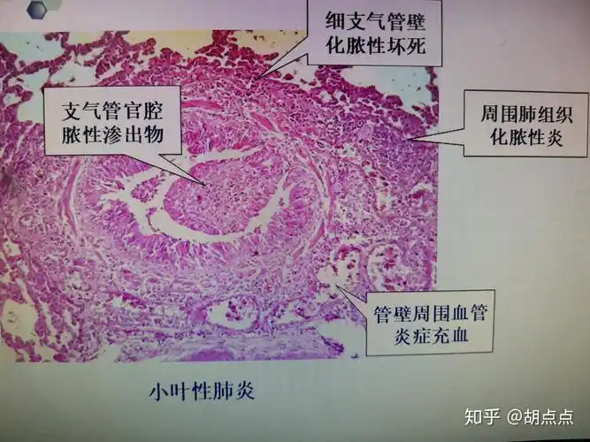 大叶性肺炎,小叶性肺炎,病理组织切片