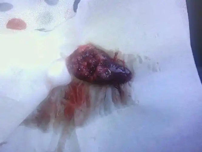 怀孕40天之内药流后流出像肉一样的东西是否流干净了