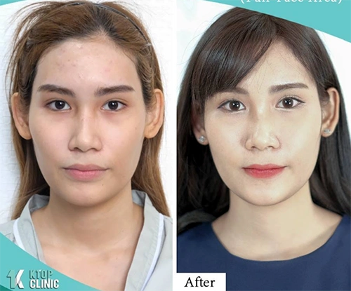 面部填充手术前后对比图