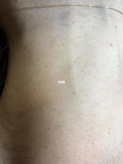 脖子扁平疣一颗就传染几十颗上百颗