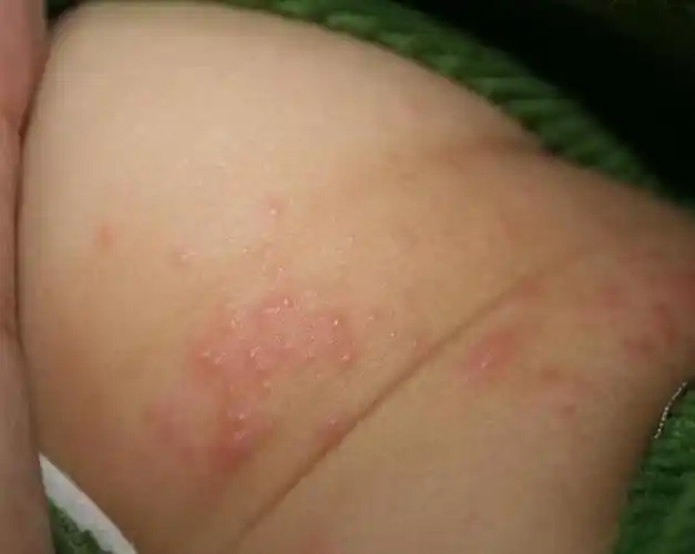 一般表现为婴儿肛门周围(尿布包裹处)出现红色斑块,丘疹,严重者还可