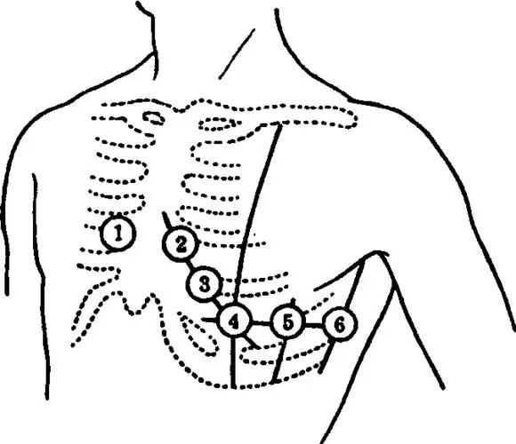 心电图导联颜色有哪些