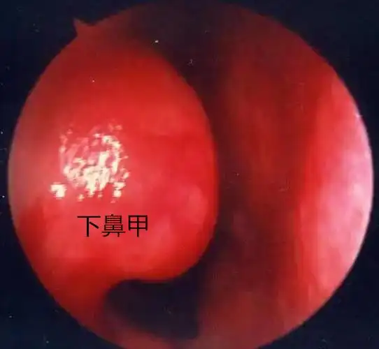 下鼻甲一侧肥大是怎么办