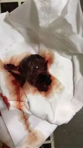 生化妊娠,一坨掉出来,有图慎入