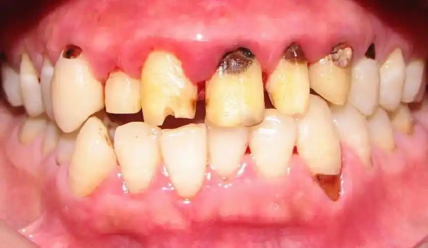 患有慢性牙周炎图片