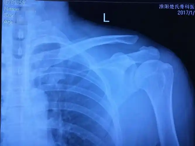 肩锁关节脱位治疗新进展