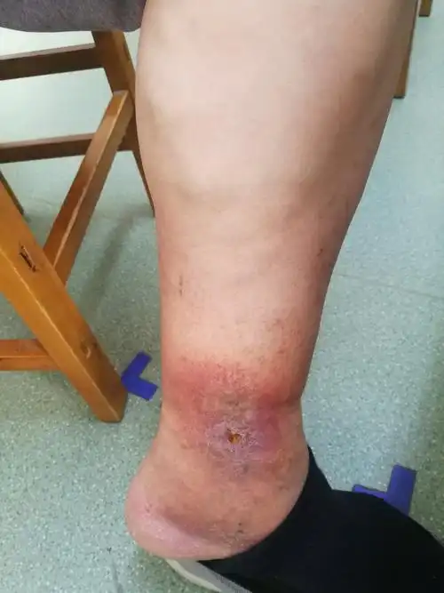 下肢静脉曲张病人的各种表现 - 好大夫在线