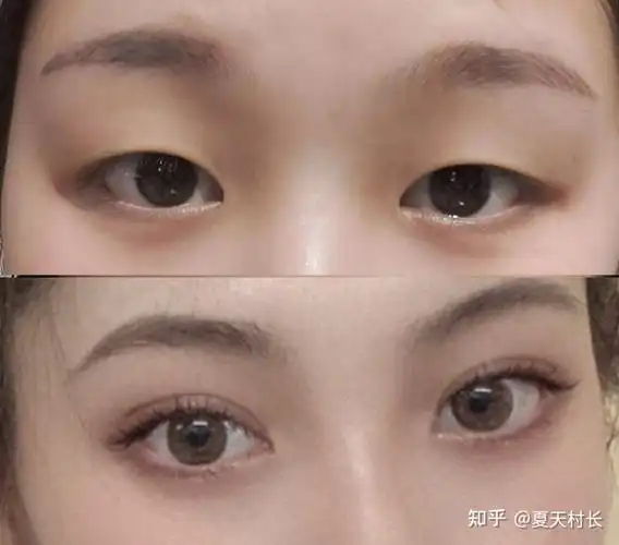 可以发一下你们开眼角的前后对比图吗