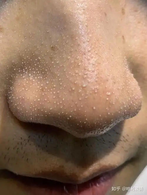 去黑头那款最好