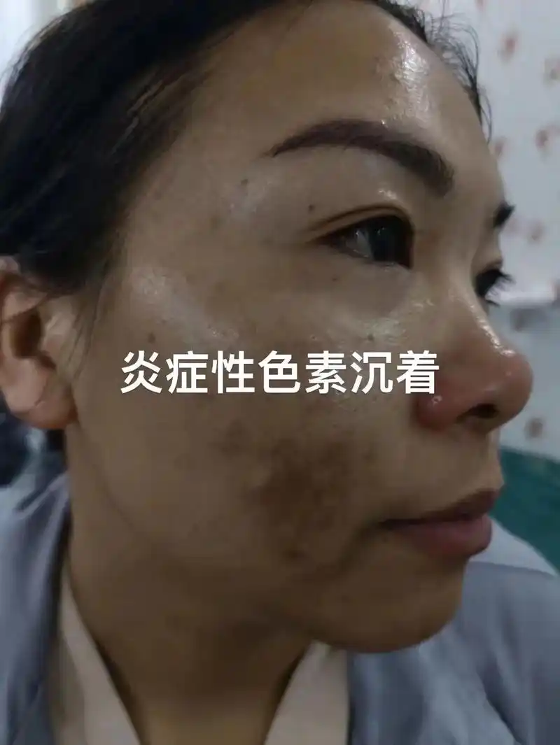 痘痘也许不可怕色素沉着可不斑斑好受