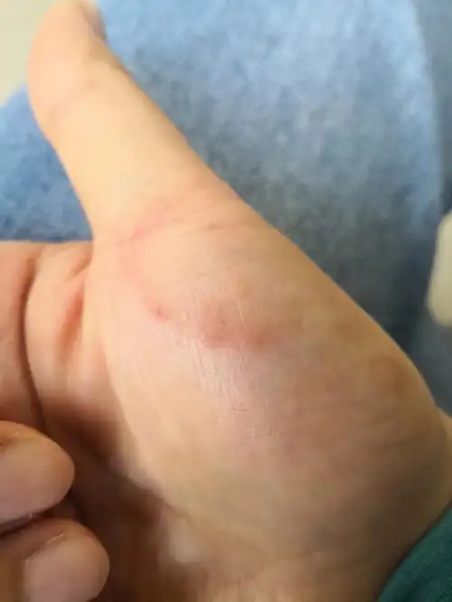 太无语了,刚开始痒,起小疙瘩感觉像小水泡,后来查了查说是汗疱疹