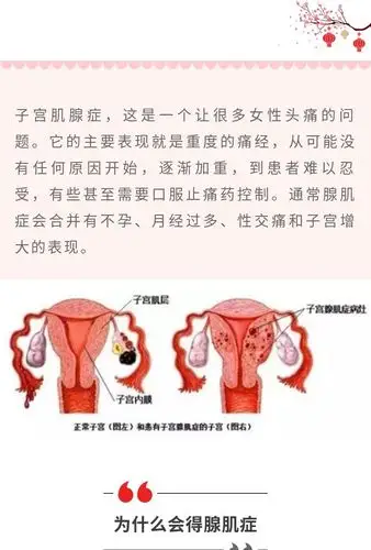 子宫腺肌症一个痛经的常见原因