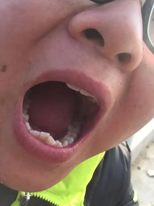 吃槟榔会这样么