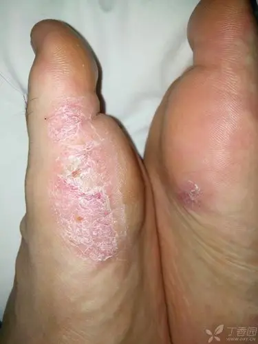 左脚掌跖侧皮损,脱屑,像是足癣