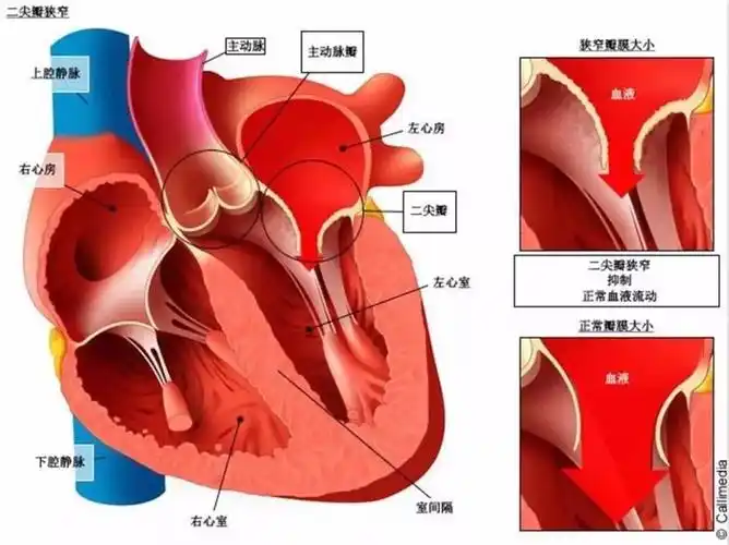 3d动画让你明明白白——经导管主动脉瓣置入术(tavi)_主动脉瓣狭窄_主