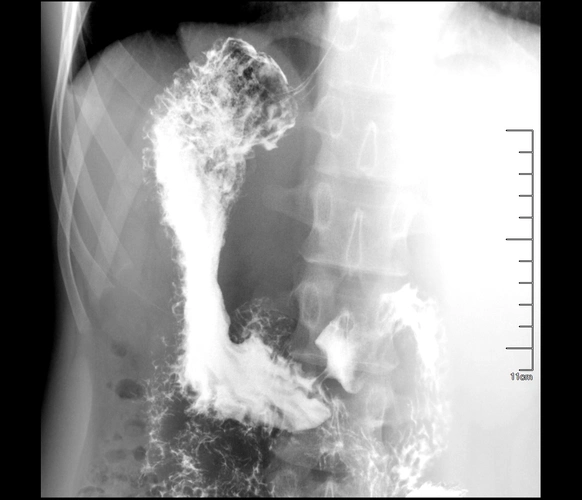空腹液,体窦部粘膜规则,壁柔软,连续,蠕动可,无明显龛影及充盈缺损