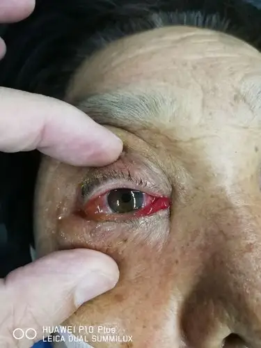 老年女性,无原因突发右眼失明,接着出现右眼球突出,球结膜水肿,到了