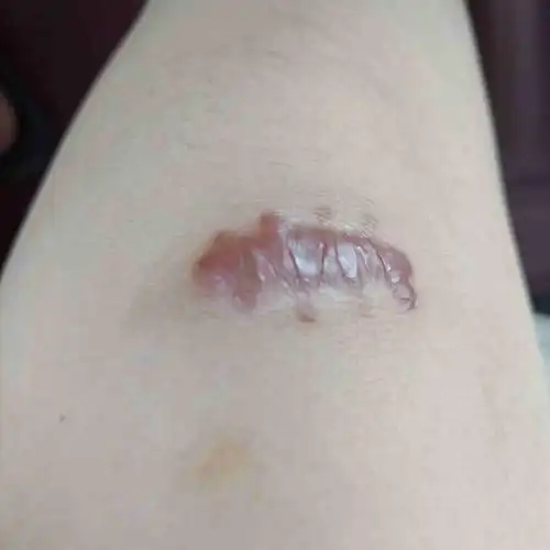 膝盖缝针可以泡水吗?