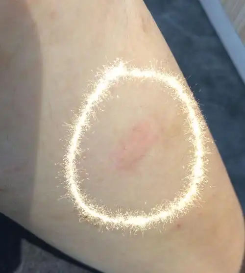 我这是螨虫过敏还是跳蚤咬了啊?刚才才长出来的.