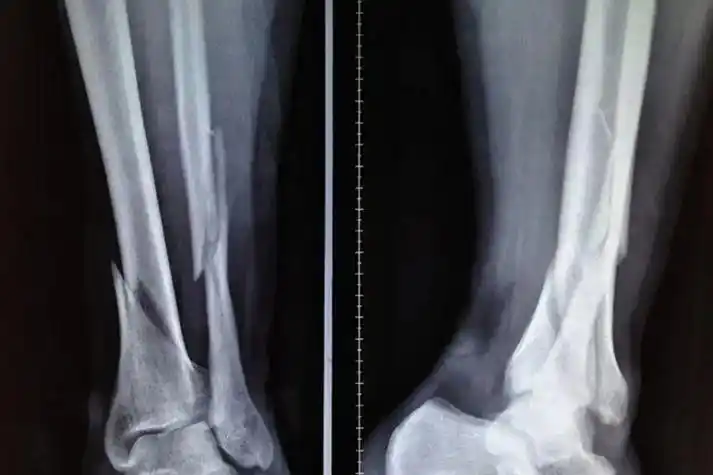 腿骨折的x光照片_有来医生