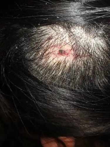 我头上缝了十几针,现在已经过去了半个月了,也拆完线了,请问伤疤附近