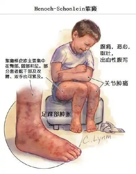 过敏性紫癜的这些危害须小心,饮食生活得注意!