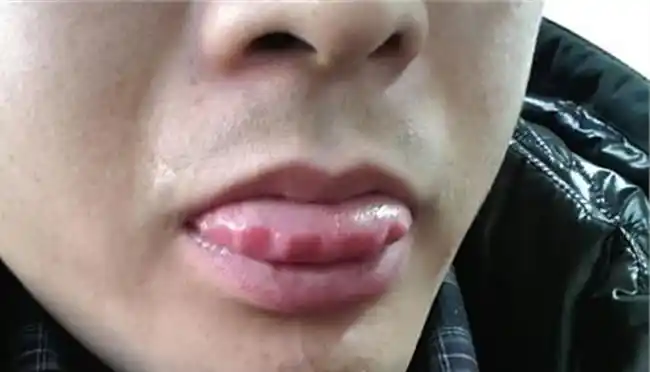 高危后口腔出现这"3病症", 或是艾滋病开始"侵犯"你