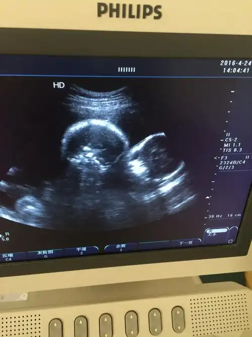 双胞胎宝宝今天的b超终于知道真相了