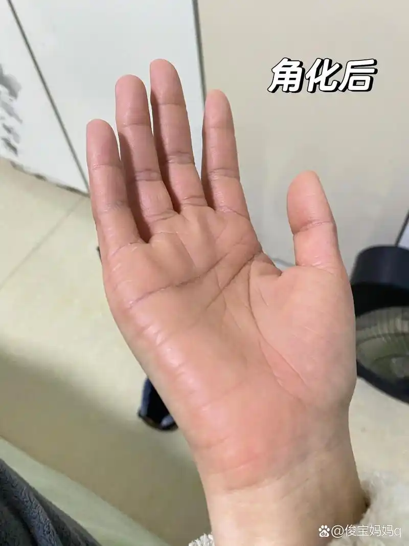 记录治疗掌跖角化症 最开始手上长了一点小水泡,用药不当使得双手整个