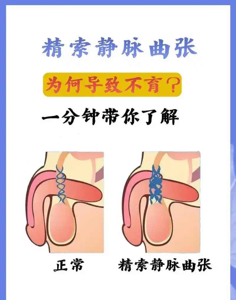 精索静脉曲张为什么会不育,一分钟带你了解!