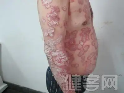 副牛皮癣的介绍