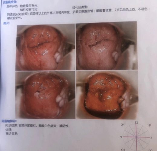 提示电子阴道镜结论宫颈糜烂3度,醋酸试验白色病变,碘试验7点处不显色