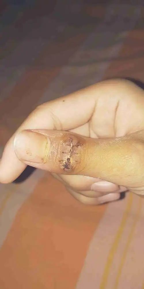 拆线后愈合的怎么样?