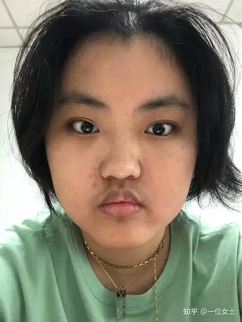 记录吃激素满月脸的恢复状况