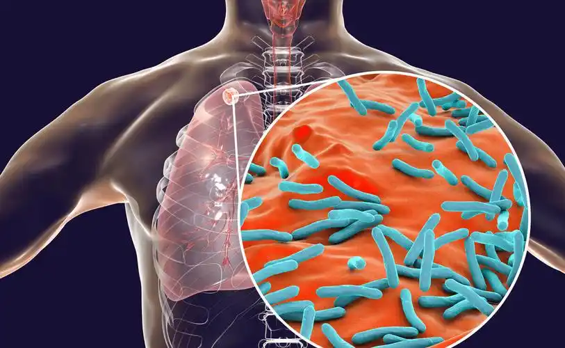 如何预防结核其实就像矛和盾加强免疫力就是加强盾的强度