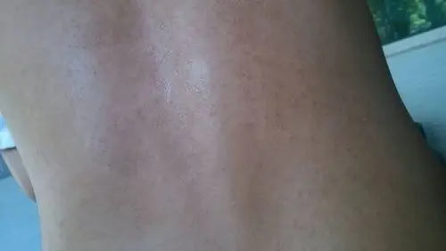 皮肤病,背部有汗斑,皮肤又得了慢性荨麻疹容易痒,这要怎么办?