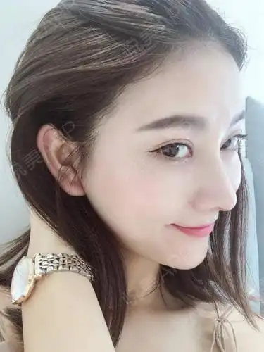 【杭州艺星鼻综合术后52天】效果越来越自然了,超开心.