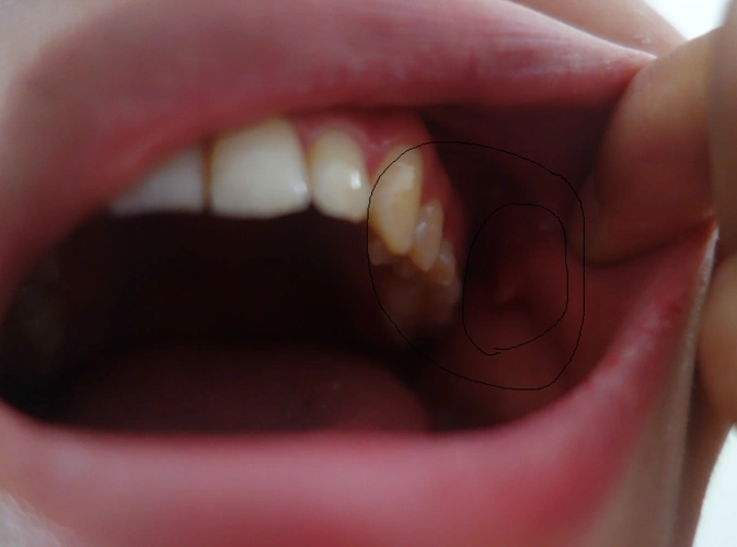 嘴里长了个肉芽一样的东西 是什么啊 用舌头碰只有根部有点疼 是上火