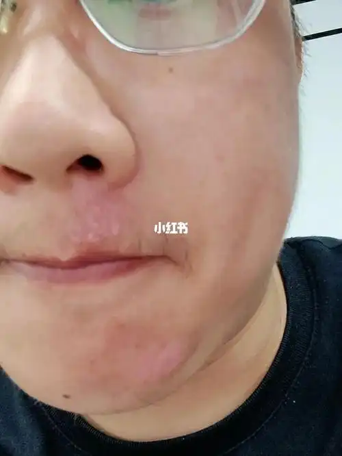 脸部擦伤第九天结痂基本掉完了本人疤痕