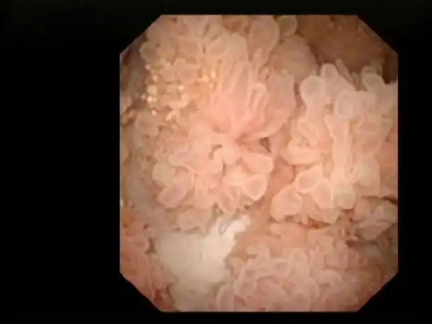 电切治疗多发大面积膀胱肿瘤保留膀胱一例