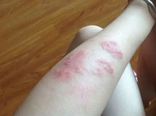 我的手臂不知道被什么虫子咬了,好几天了越来越严重