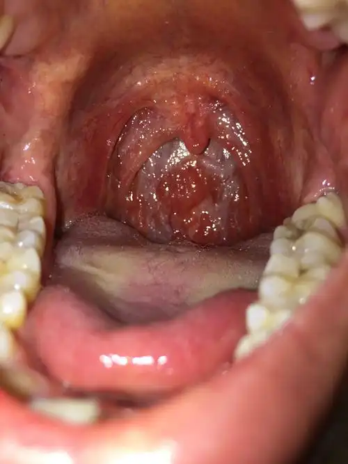 请问我这个是咽喉炎吗?