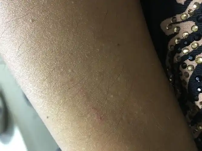 大家帮忙看看这是狗咬的伤口吗?