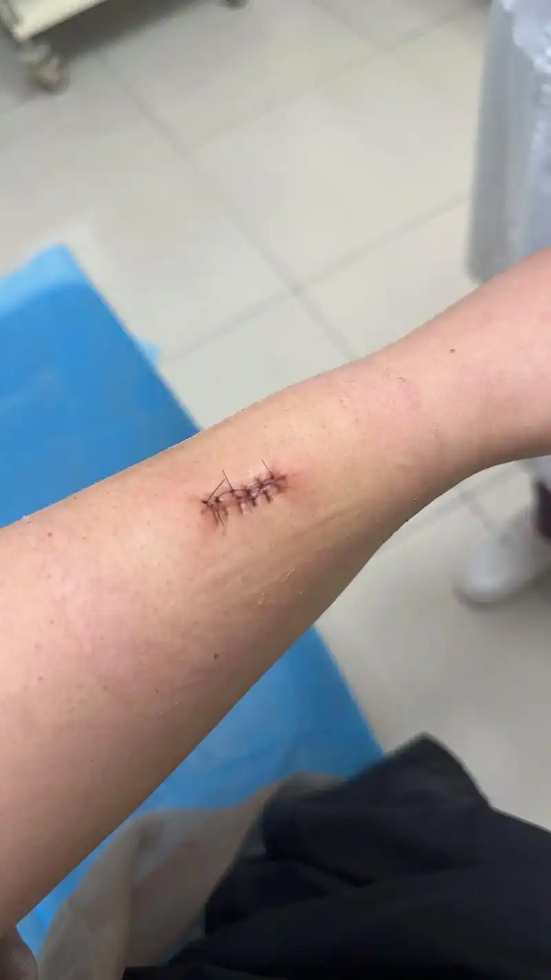 原来外科手术的缝针是这个样子的,因为这两处刀口有幸体验了一把 - 抖