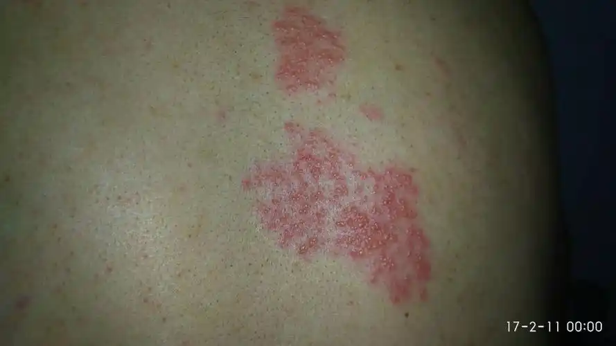 前天后背起了小红疙瘩 不疼不痒 现在需要用药吗 饮食需要注意什么?