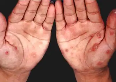 女性淋病的早期症状